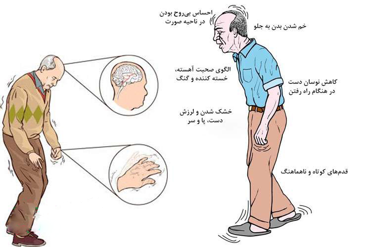 بیماری-پارکینسون و آلزایمر